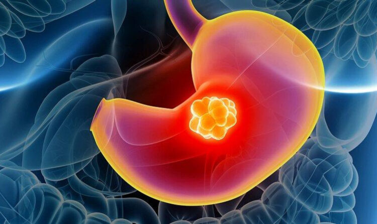 Лечение рака желудка