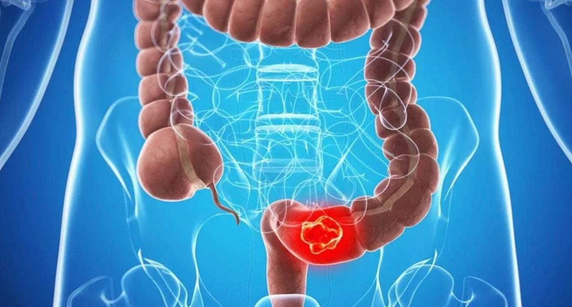 Лечение рака толстой кишки