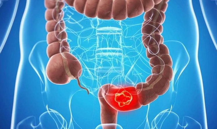 Colon Cancer Treatment