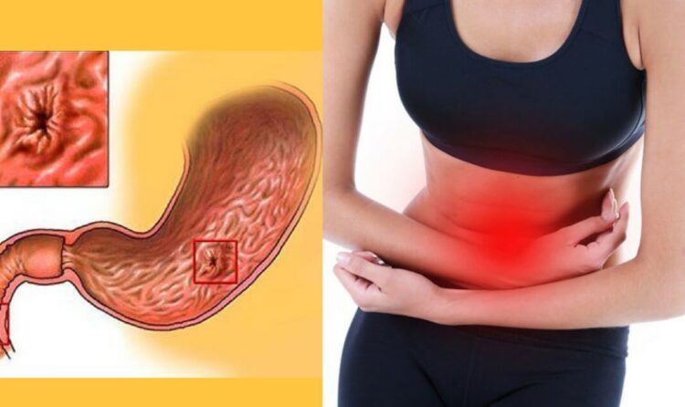 Что такое язва желудка?