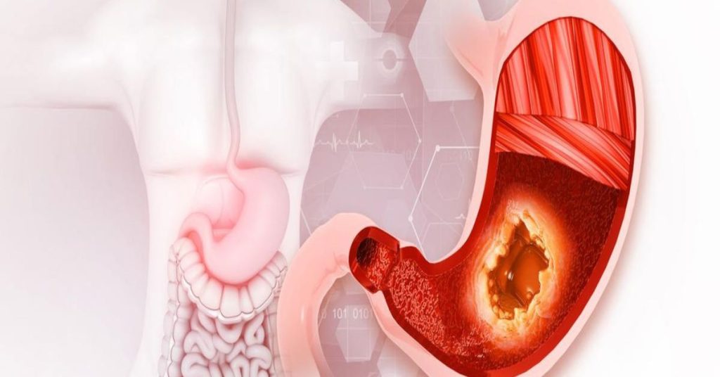 Mide Ülseri Hastalığı Nedir?