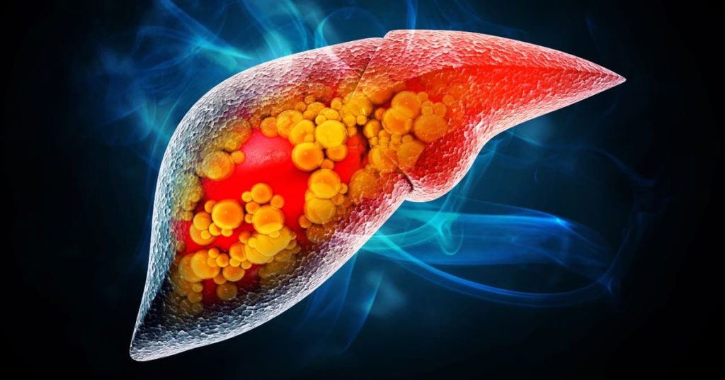 What is Cirrhosis?