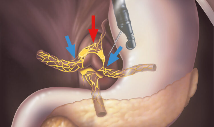Что такое эндоскопическая фундопликация?