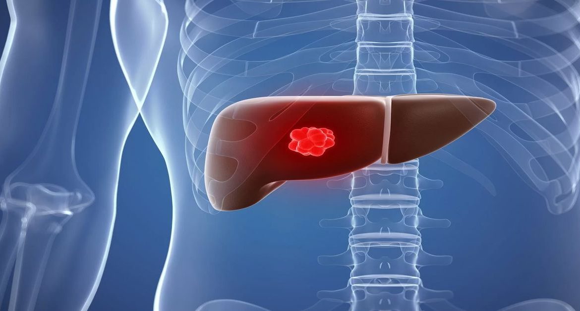 Что такое рак печени?