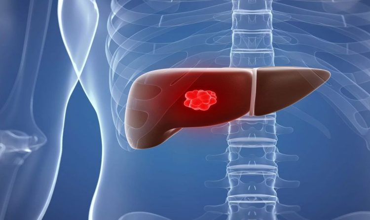 Karaciğer Kanseri Nedir?