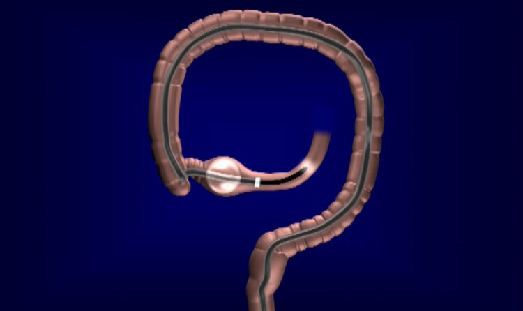 Entéroscopie par ballonnet