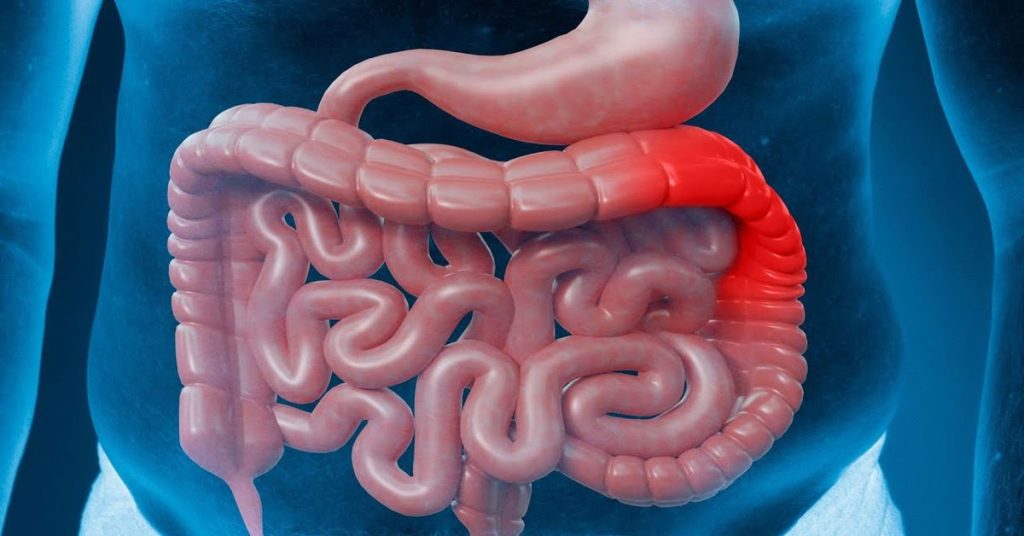 Symptome von Morbus Crohn