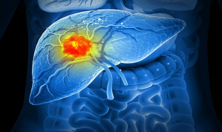 Karaciğer Kanseri Tedavisi