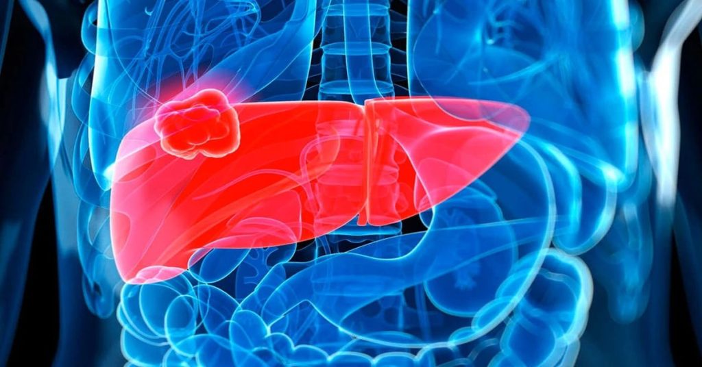 Лечение рака печени