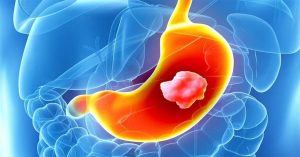 Mide Fıtığı Ameliyatı