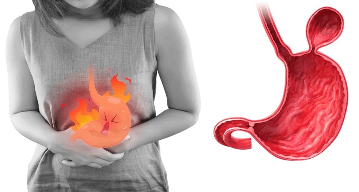 Mide Fıtığı Ameliyatı