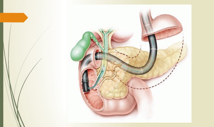 Что такое ЭРХПГ?