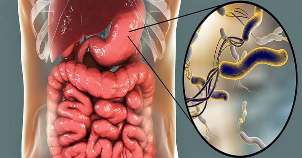 Traitement de l'Helicobacter Pylori
