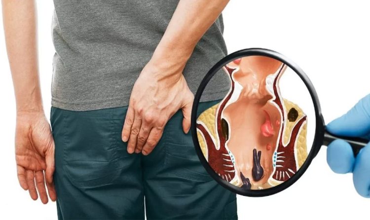 Хирургия геморроя