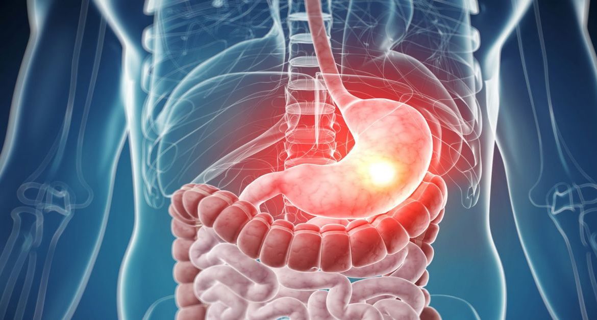 Mide Fıtığı Nedir?