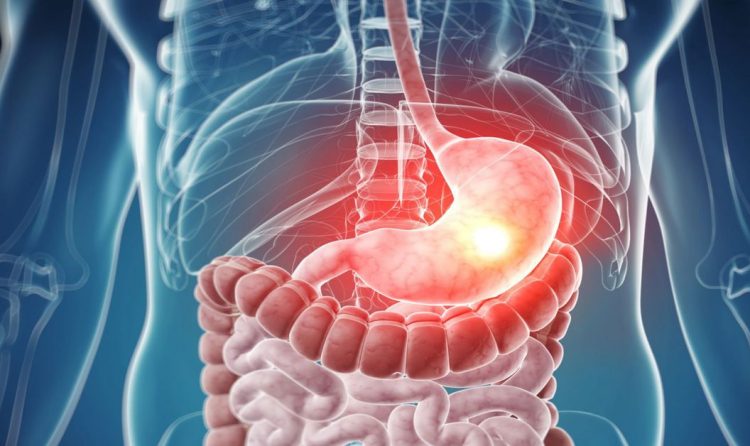 Что такое Хиатальная грыжа?