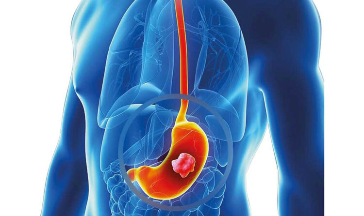 Хирургия рака желудка