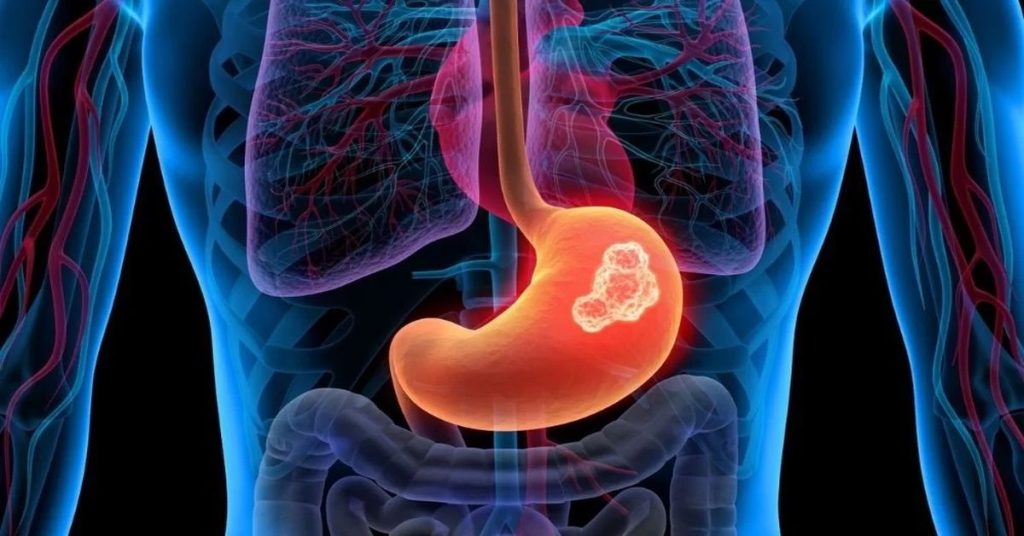 Stomach Cancer Symptoms