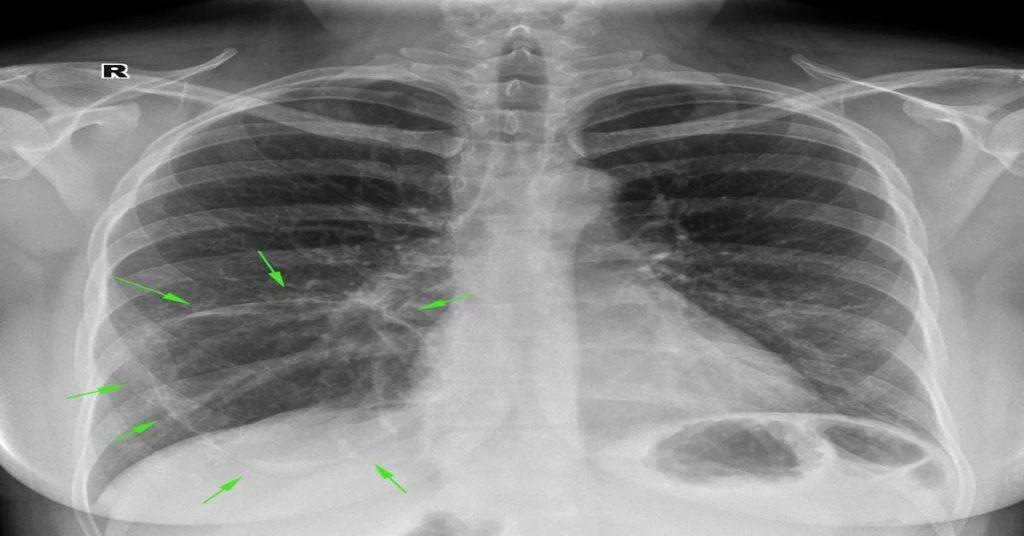 Aspirationspneumonie