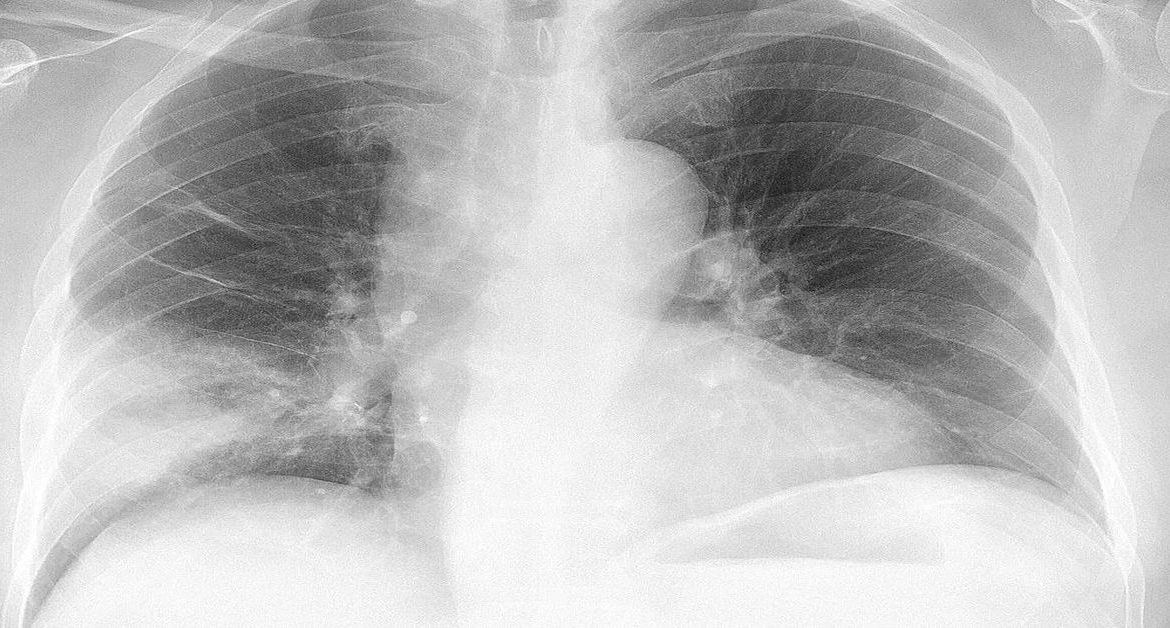 Aspirationspneumonie