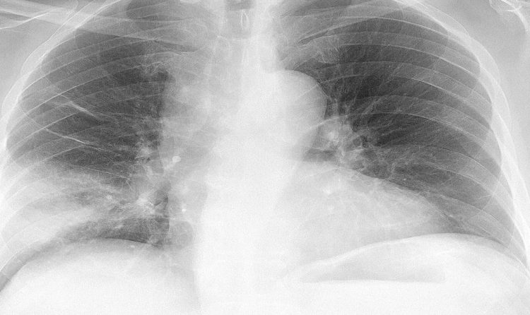 Aspirasiyon Pnömonisi