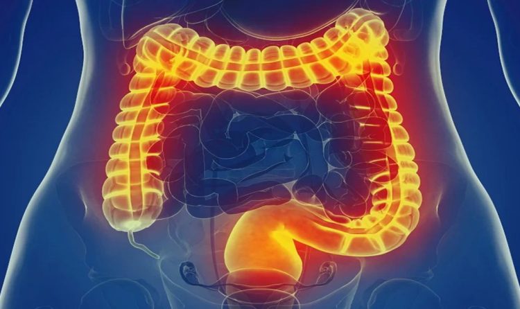 Синдром раздраженного кишечника