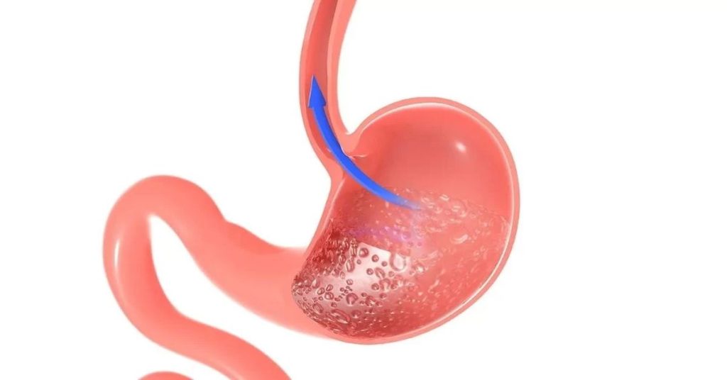 Wie entsteht Reflux?