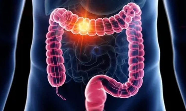 Rectal Cancer Treatment