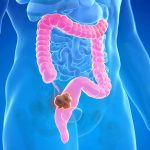 Rektum Kanseri Nedir?