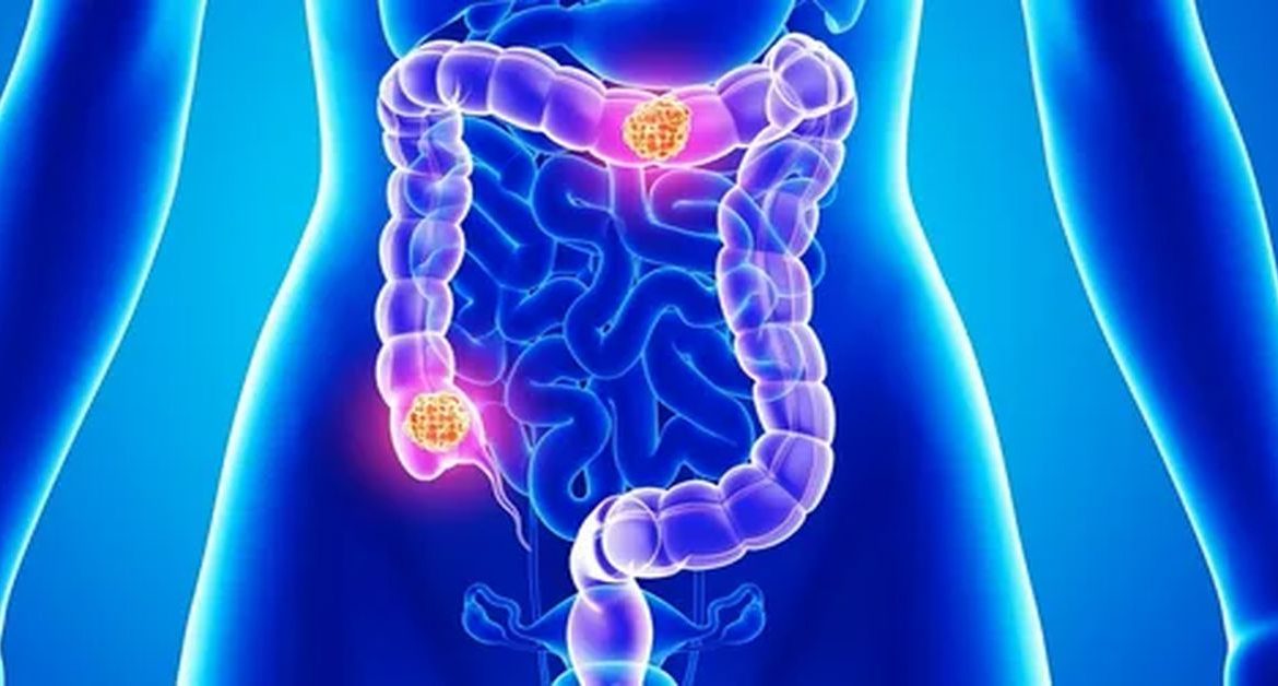 Kolon Kanseri Tedavisi Nedir?