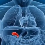 Safra Yolu Tıkanıklığı Tedavisi