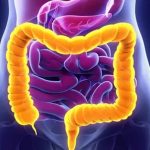 Ülseratif Kolit Ameliyatı